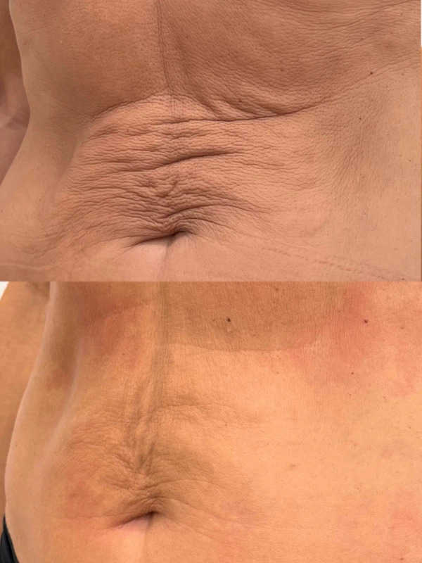 belly-tight-caa-caso-1 belly-tight-caa-caso-1