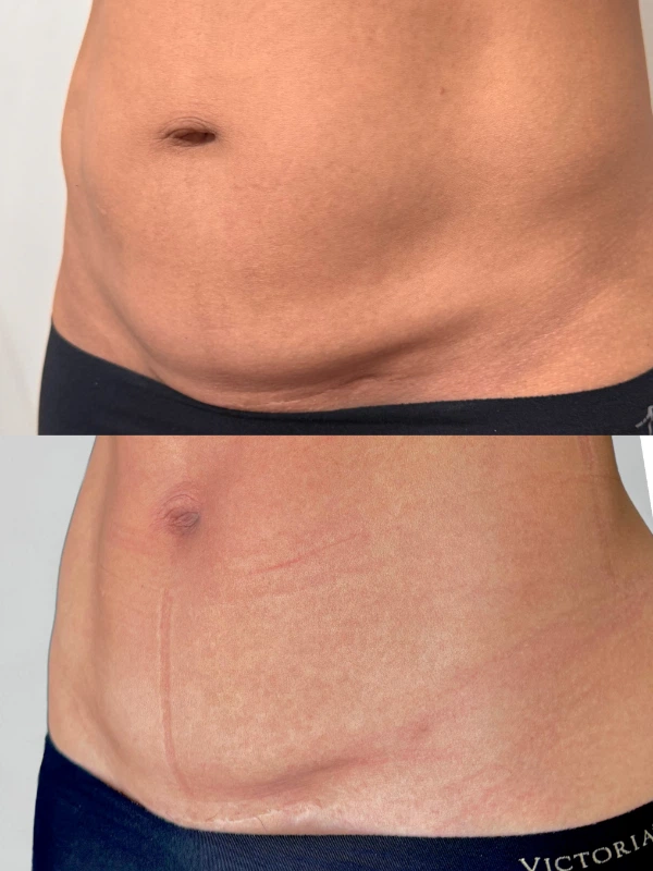 belly-tight-caa-caso-2 belly-tight-caa-caso-2