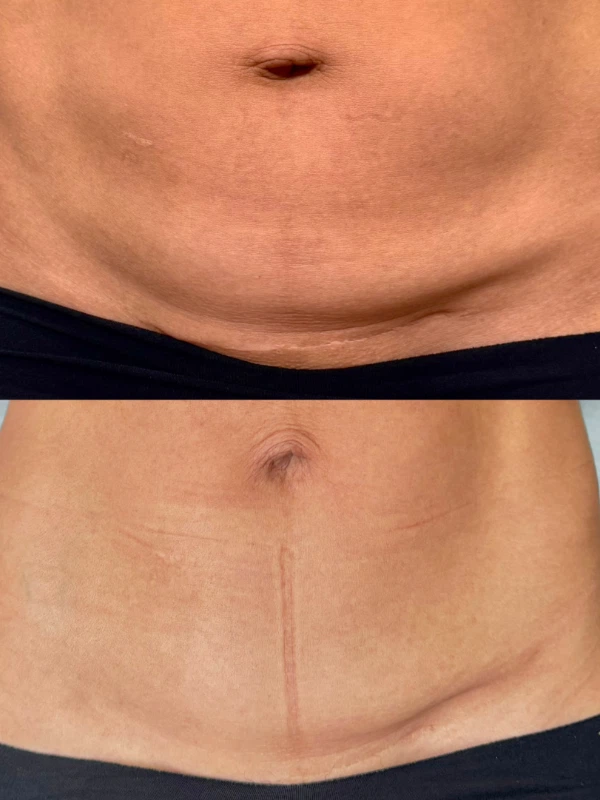 belly-tight-caa-caso-3 belly-tight-caa-caso-3