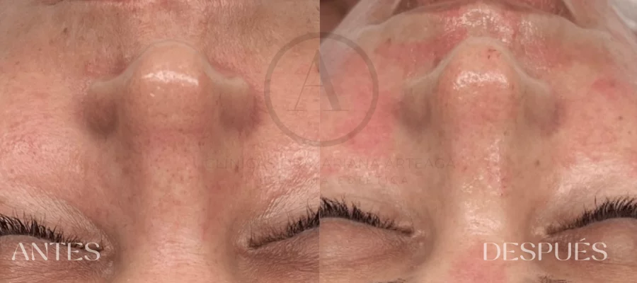 Antes y después tratamiento higiene facial profundo Valencia