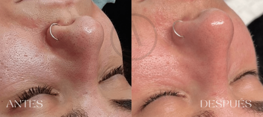 Higiene Facial antes y después