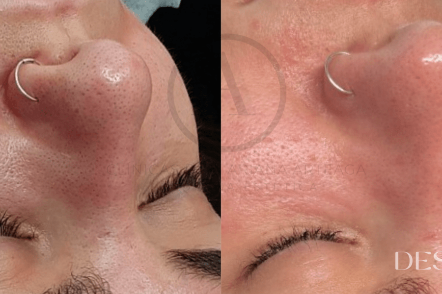 Higiene Facial antes y después