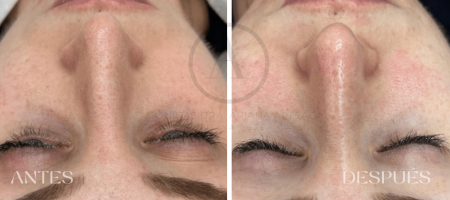 Higiene Facial Profunda en Valencia