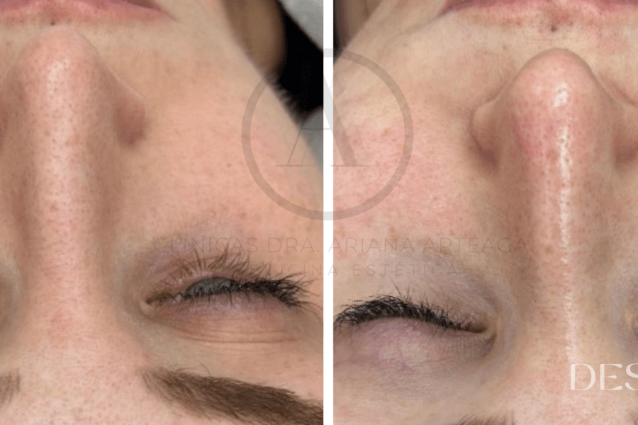 Higiene Facial Profunda en Valencia