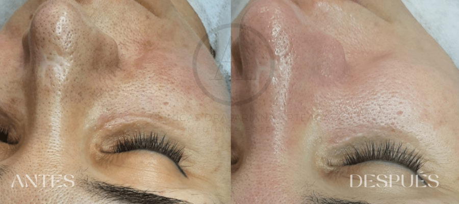 Higiene Facial Profunda Valencia