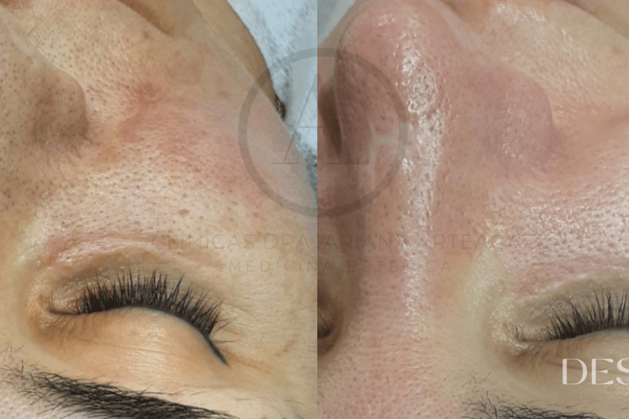 Higiene Facial Profunda Valencia