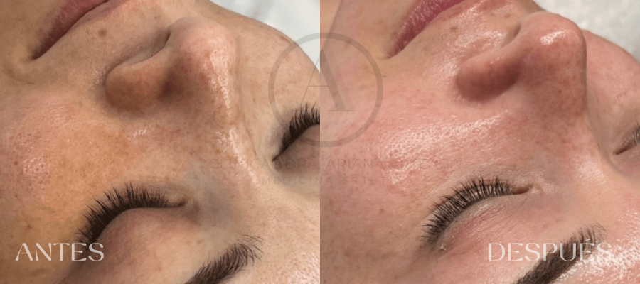 Tratamiento Higiene Facial