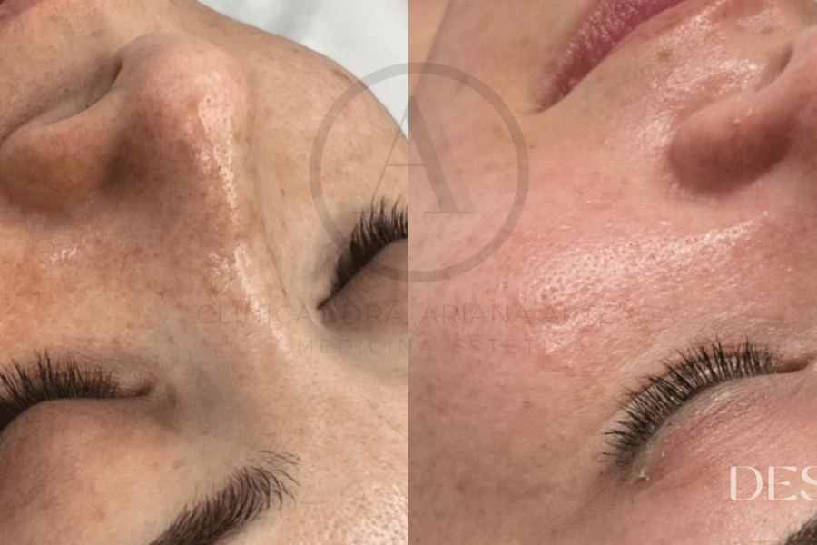 Tratamiento Higiene Facial