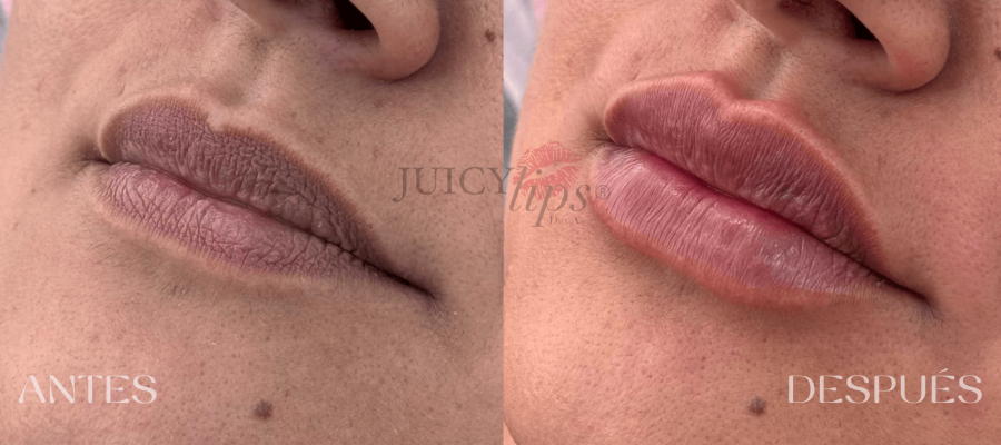 JUICY LIPS® Relleno de labios valencia