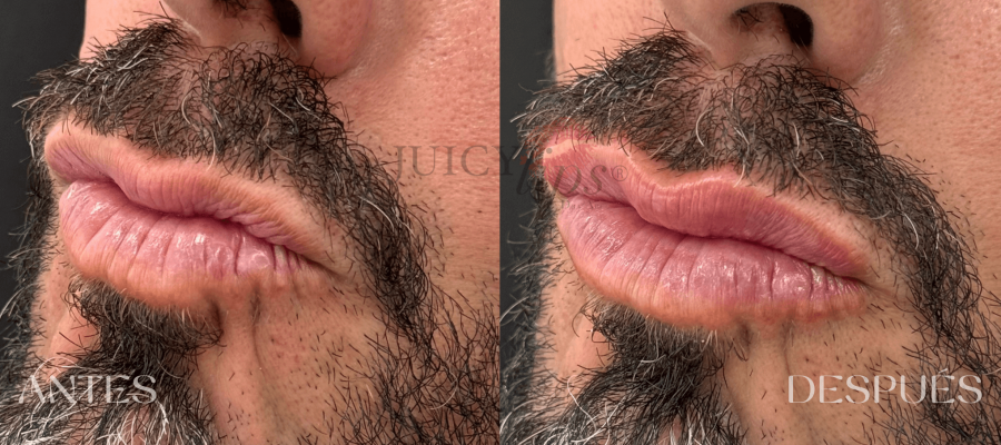 Relleno de Labios en hombres España
