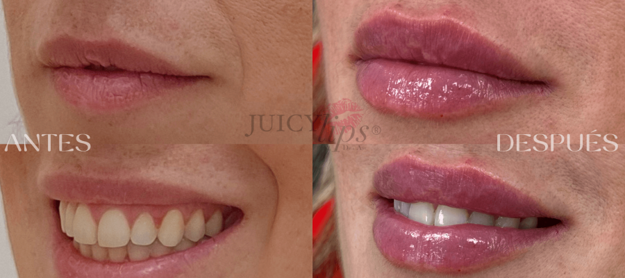 Relleno de Labios JUICY LIPS® Clínicas Ariana Arteaga