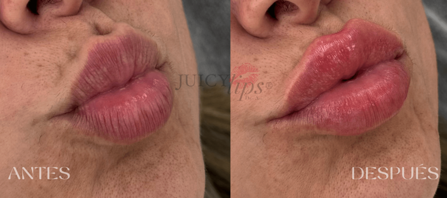 Relleno de Labios España