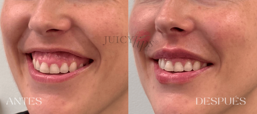 Aumento de labios España JUICY LIPS®