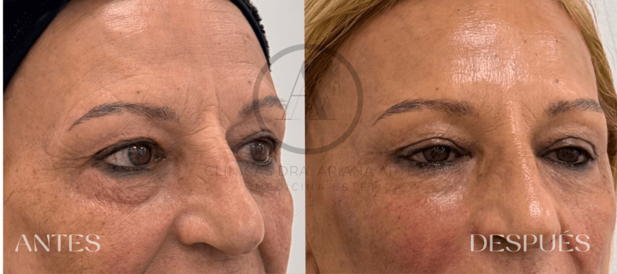 Mesoterapia Facial Casos antes y después España