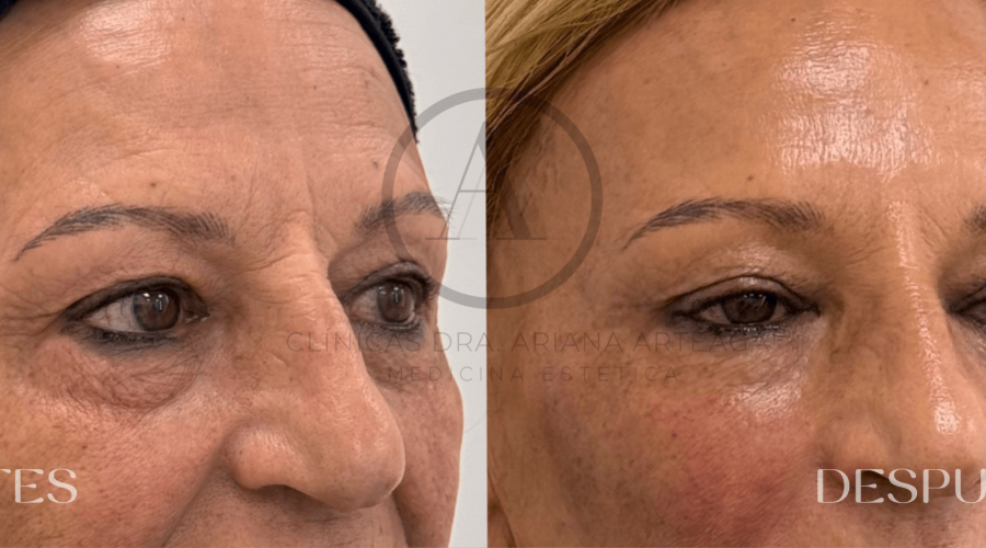 mesoterapia-facial