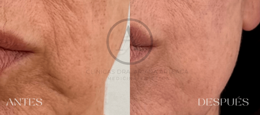 Mesoterapia Facial Casos antes y después España Valencia