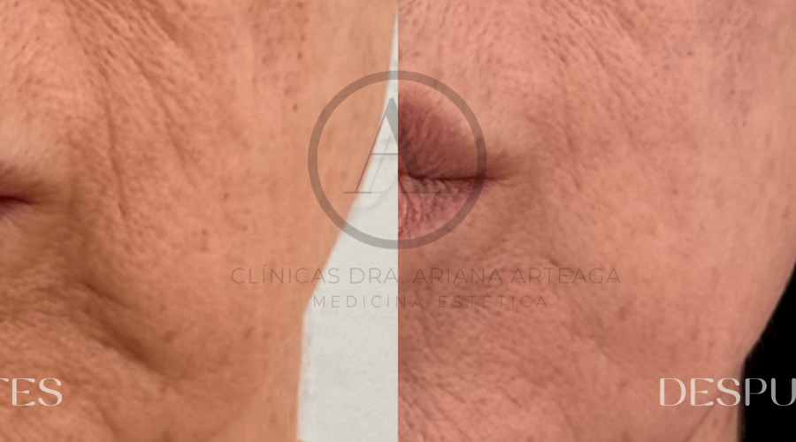 mesoterapia-facial-valencia