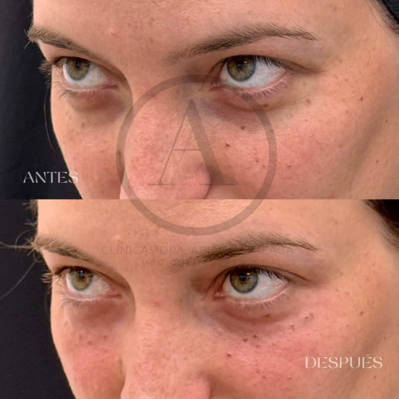 Casos de antes y después Ojeras Valencia