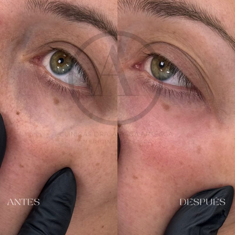 Casos de antes y después Ojeras Valencia España