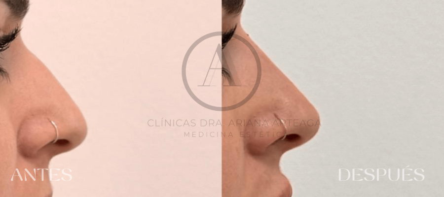 Rinomodelado sin cirugía Casos antes y después España