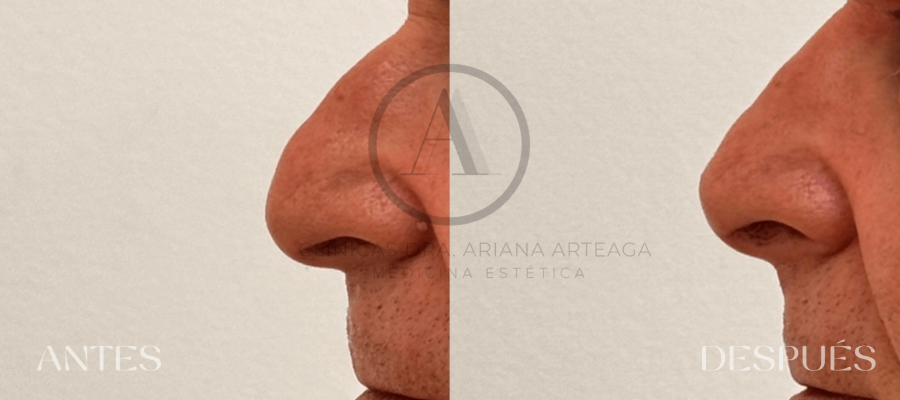 Rinomodelado sin cirugía Casos antes y después Valencia