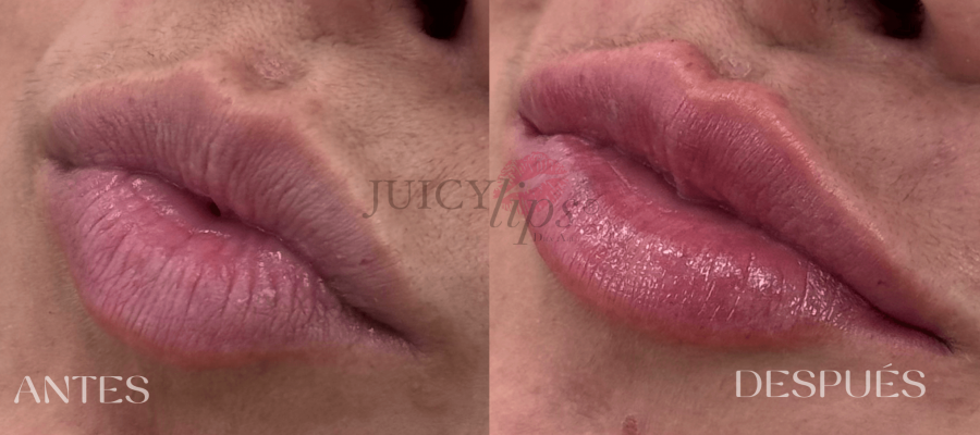JUICY LIPS® Casos de antes y después Valencia España