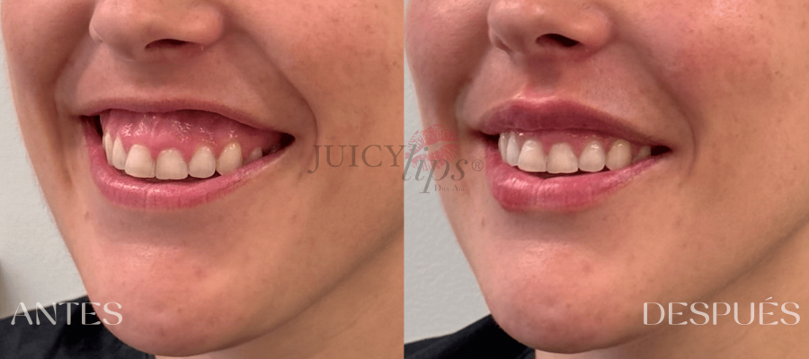 CASOS ANTES Y DESPUÉS DE JUICY LIPS®