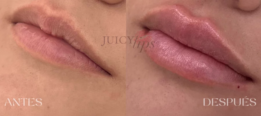 Casos antes y después Aumento de Labios Ariana Arteaga