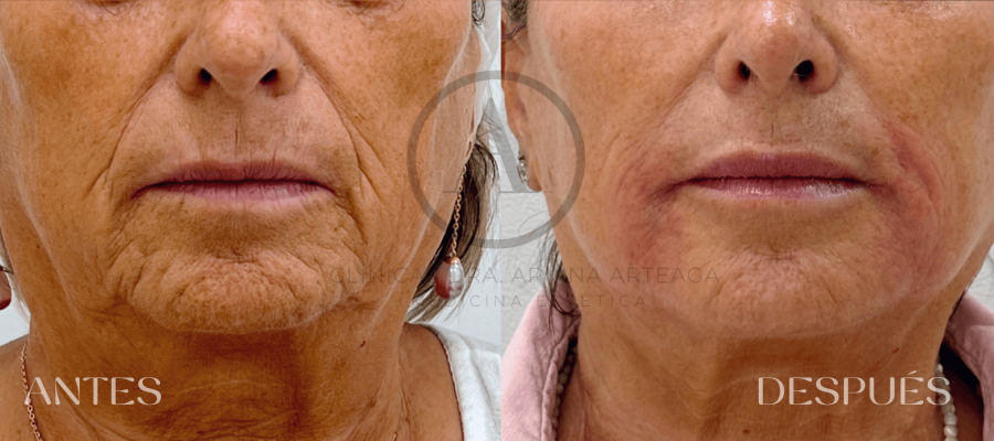 Mesoterapia Facial Casos antes y después Clínicas Ariana Arteaga