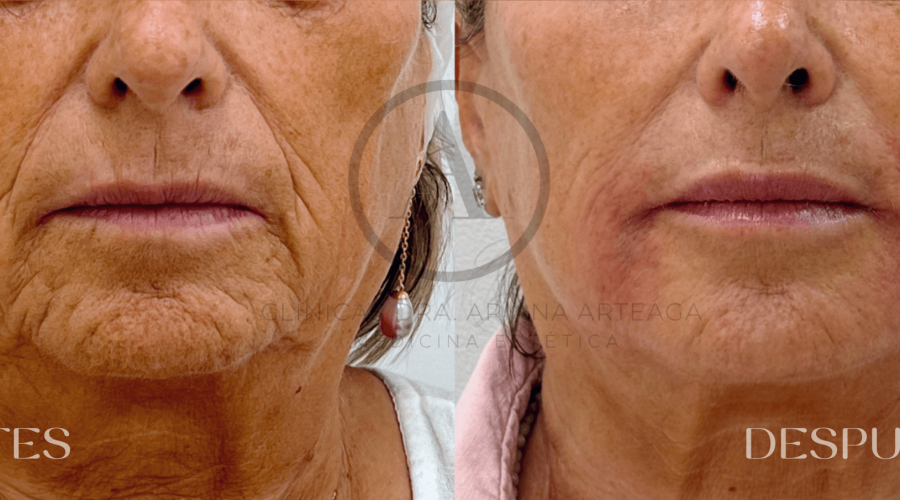 tratamiento-mesoterapia-facial