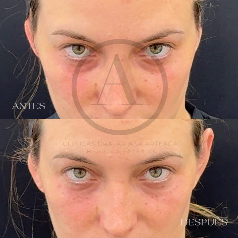 Tratamiento Ojeras España