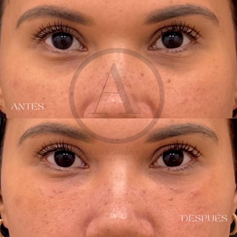 Tratamiento Ojeras Casos de antes y después