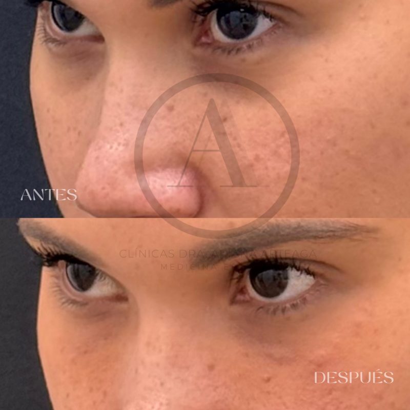 Casos de antes y después Tratamiento Ojeras España