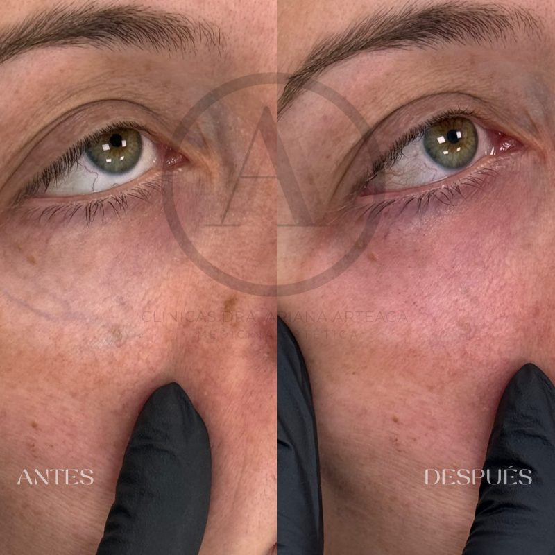 Tratamiento Ojeras Casos de antes y después Valencia