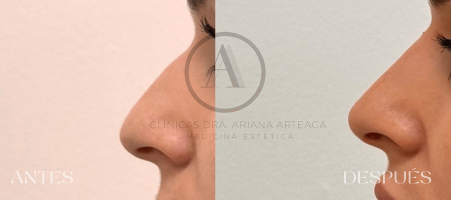 Rinomodelación Casos antes y después España